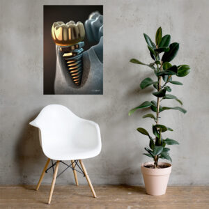 Dental Implant Golden II