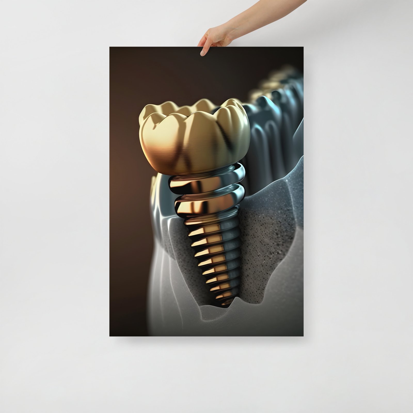 Golden implant